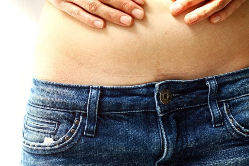 Meine Kaiserschnitt-Erfahrung: Ein ehrlicher Bericht