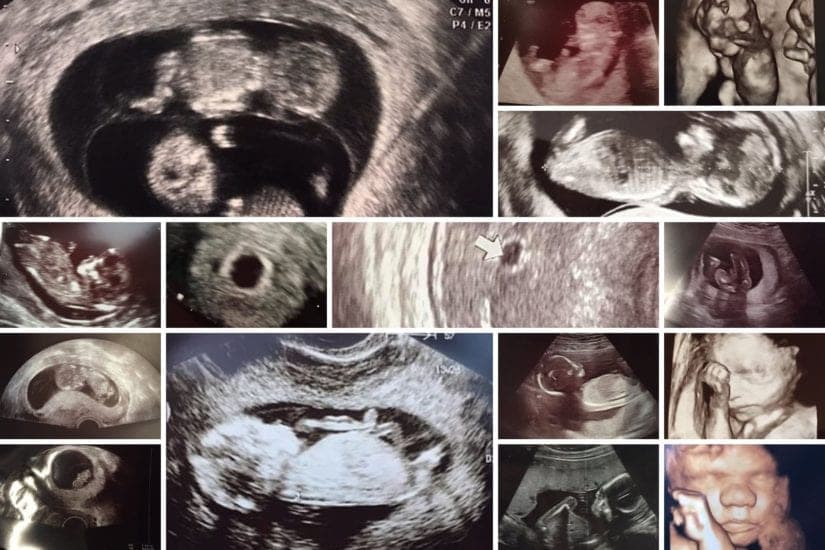 Ultraschallbilder: 50+ Bilder aus der Schwangerschaft