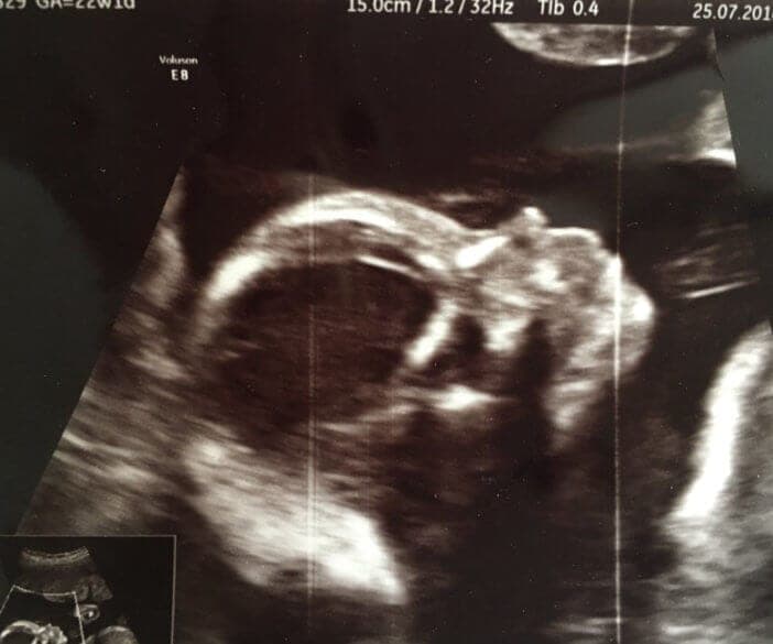 Erweiterter Basis-Ultraschall: Was wird untersucht?