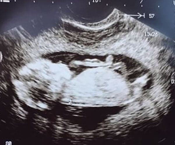 ultraschall 11 ssw junge