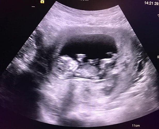 ultraschall 11 ssw junge1