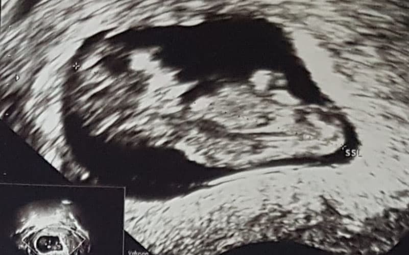 ultraschall 11 ssw maedchen