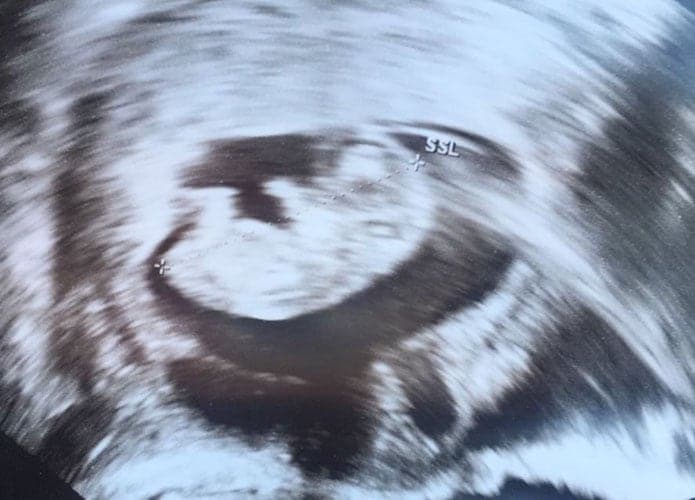 ultraschall 11 ssw maedchen1