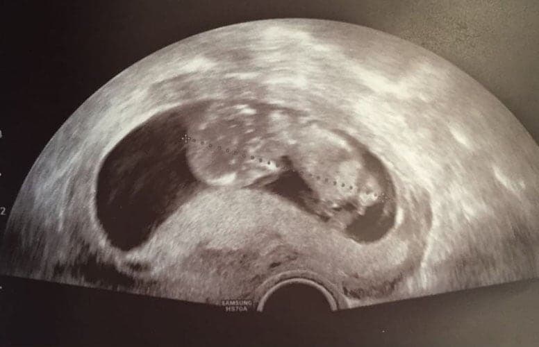 ultraschall 12 ssw junge