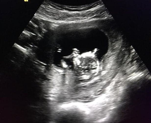 ultraschall 12 ssw junge1