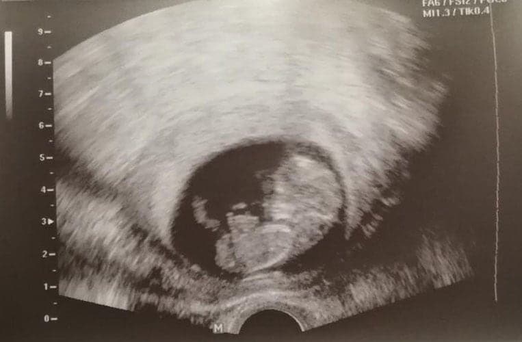 ultraschall 12 ssw junge2