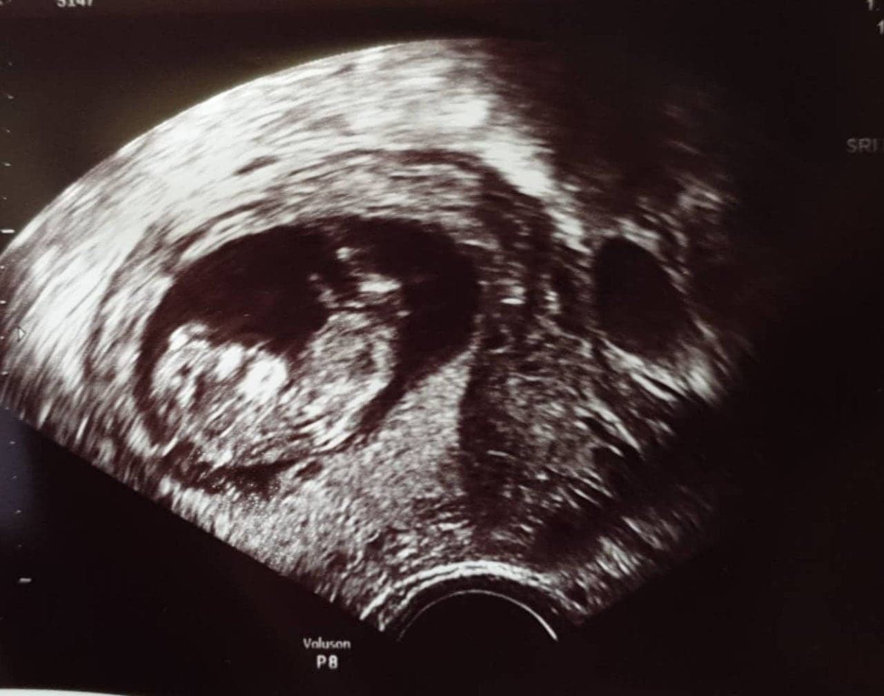 ultraschall 12 ssw junge3