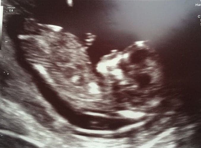 ultraschall 12 ssw maedchen