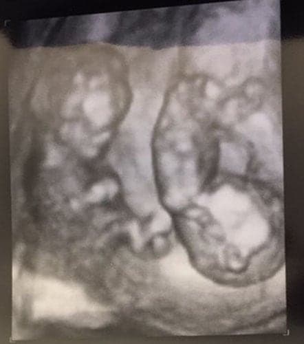 ultraschall 12 ssw zwillinge-jungs