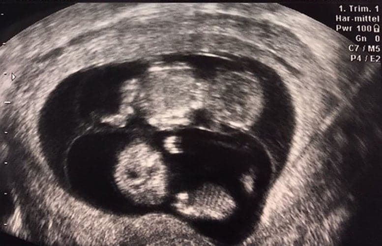 ultraschall 12 ssw zwillinge-jungs1