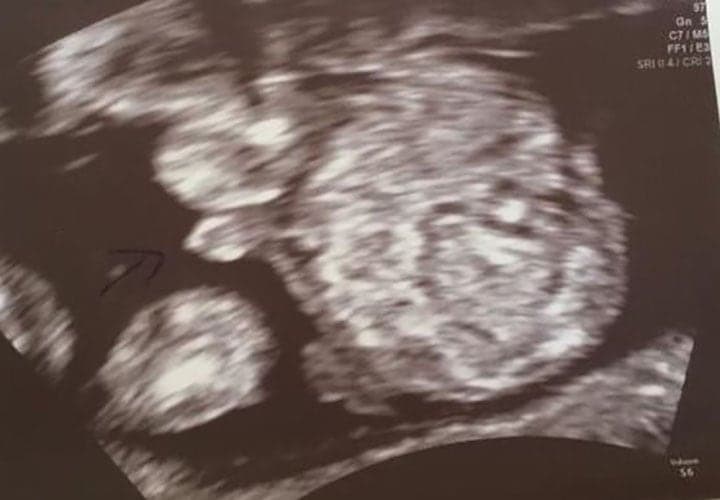 ultraschall 13 ssw junge