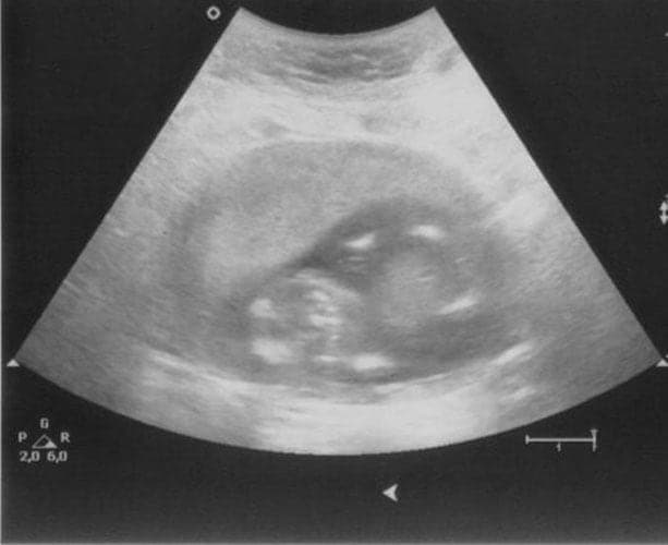 ultraschall 14 ssw junge