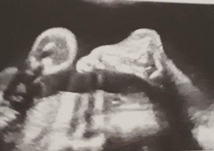 ultraschall 14 ssw maedchen