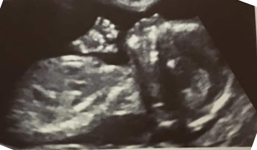 ultraschall 14 ssw maedchen1