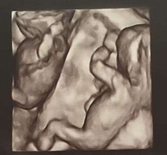 ultraschall 14 ssw zwillinge-jungs