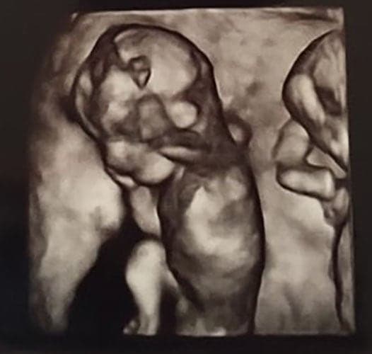 ultraschall 14 ssw zwillinge-jungs1