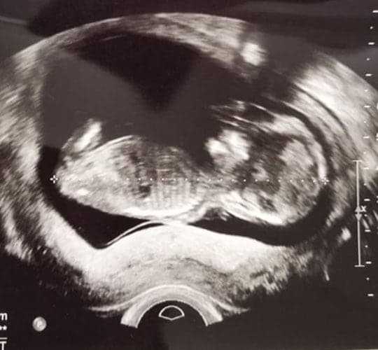 ultraschall 15 ssw