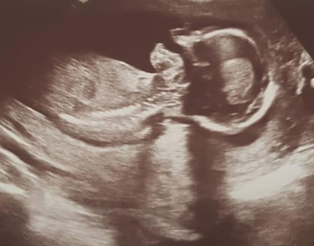 ultraschall 16 ssw junge