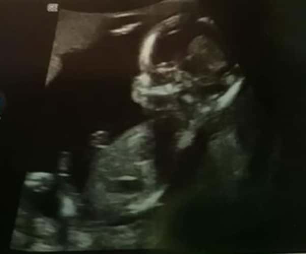 ultraschall 16 ssw maedchen