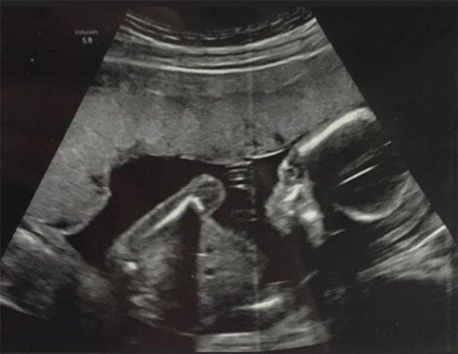 ultraschall 18 ssw junge