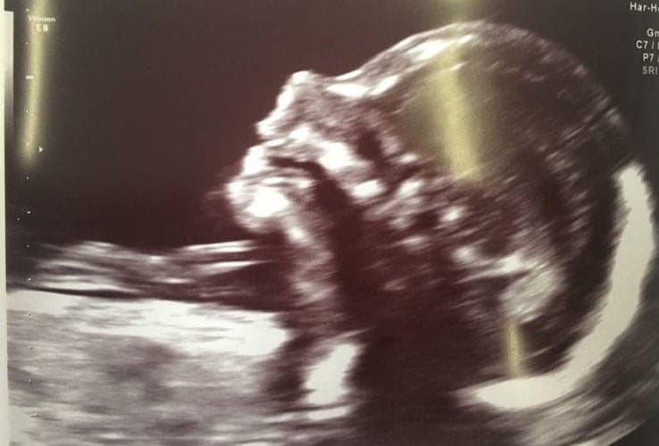 ultraschall 19 ssw maedchen