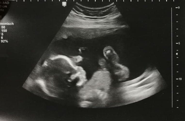 ultraschall 20 ssw junge