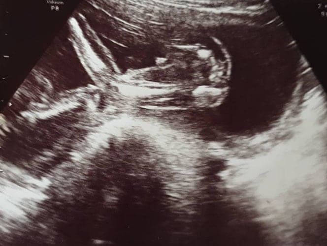 ultraschall 20 ssw junge1