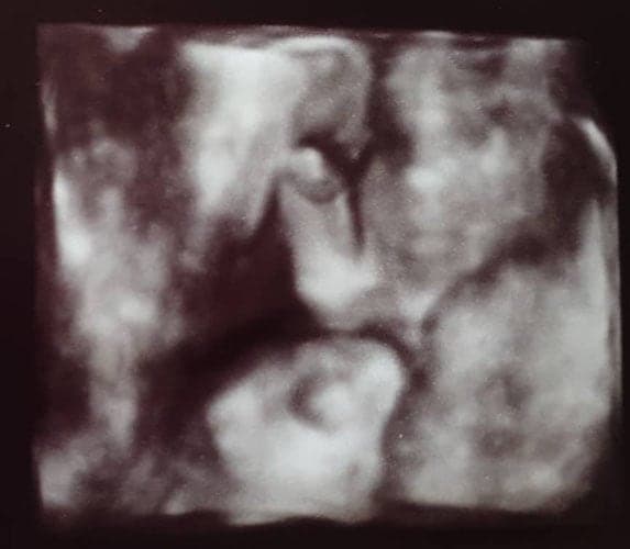 ultraschall 20 ssw junge2