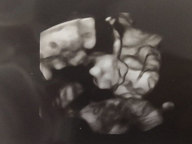 ultraschall 22 ssw junge