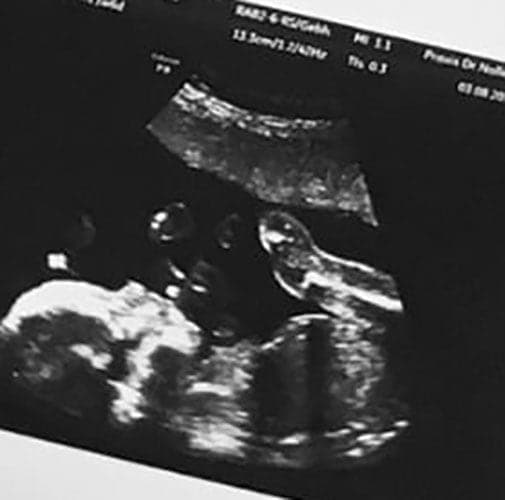 ultraschall 22 ssw junge1