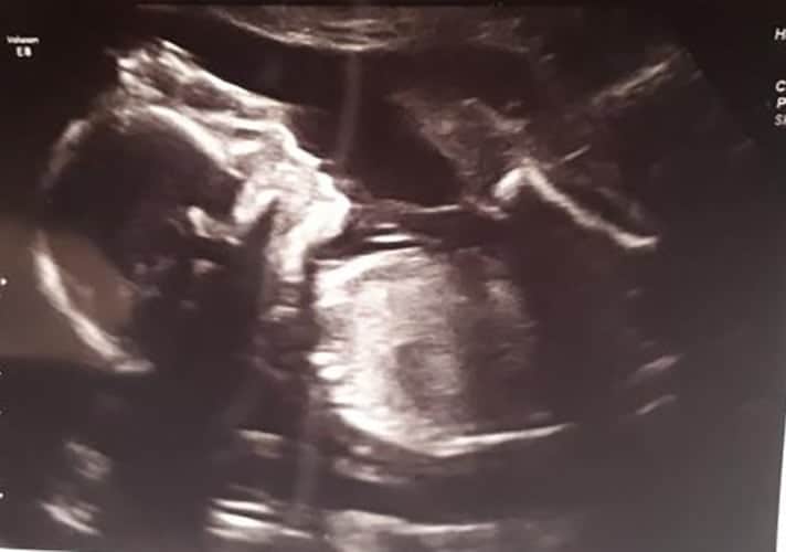 ultraschall 23 ssw maedchen