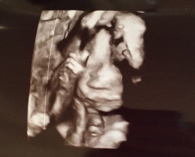 ultraschall 24 ssw junge