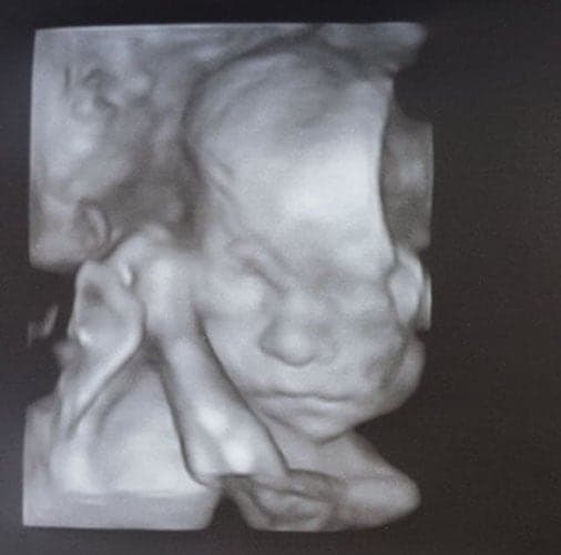 ultraschall 24 ssw maedchen