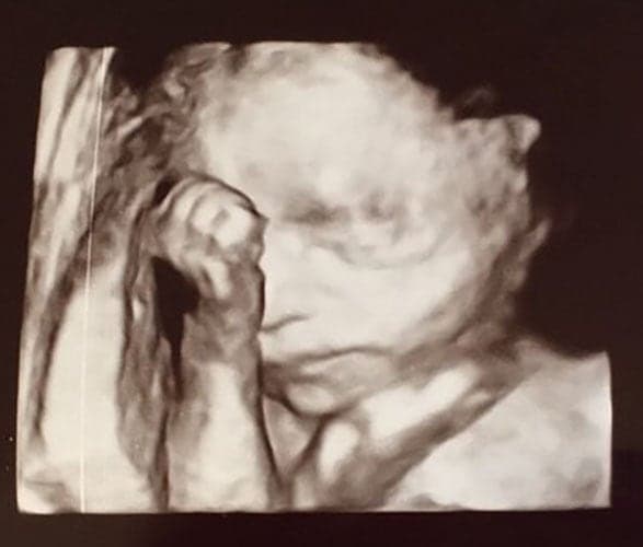 ultraschall 25 ssw junge1