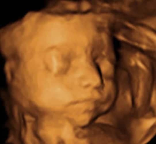 ultraschall 26 ssw junge