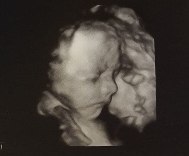 ultraschall 27 ssw junge