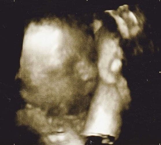 ultraschall 30 ssw maedchen