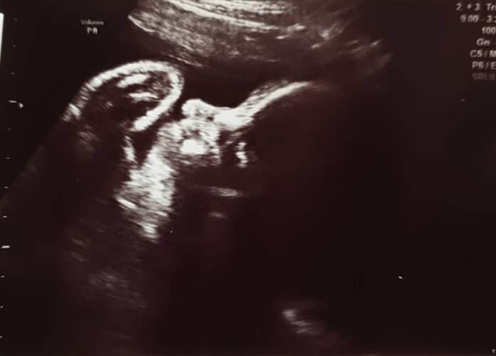 ultraschall 31 ssw junge