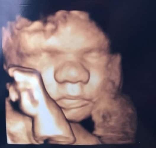 ultraschall 32 ssw junge1