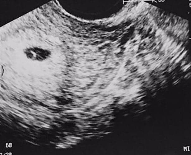 ultraschall 4 ssw junge