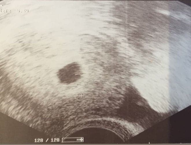 ultraschall 5 ssw junge