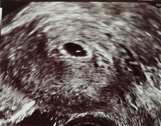 ultraschall 6 ssw junge