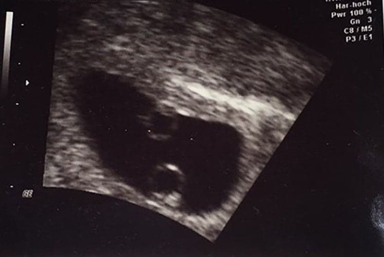 ultraschall 7 ssw zwillinge-jungs