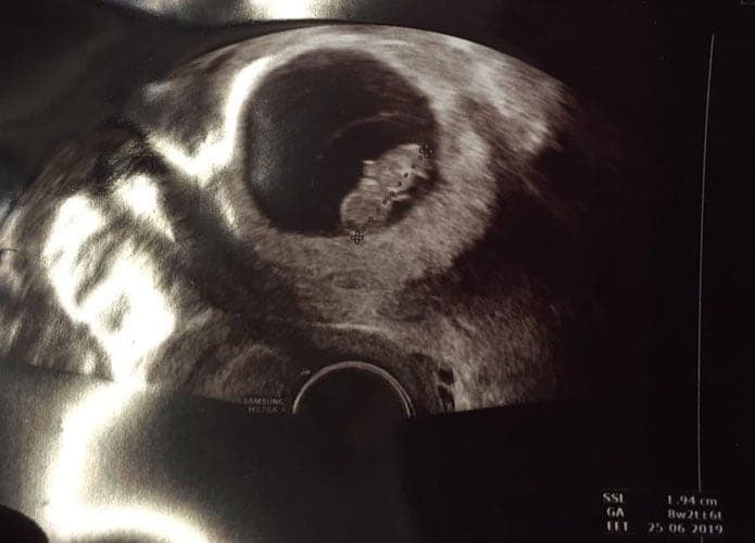 ultraschall 8 ssw junge