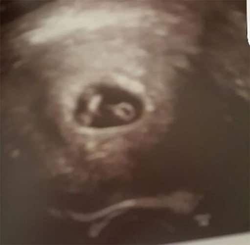 ultraschall 8 ssw zwillinge