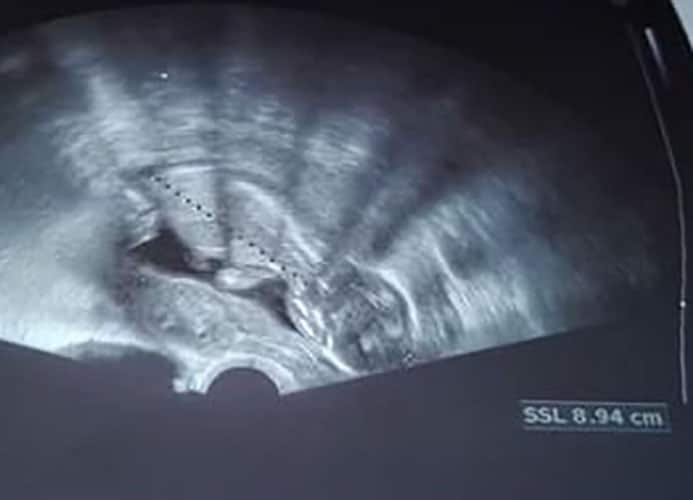 ultraschall 8 ssw