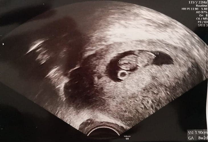 ultraschall 9 ssw junge1