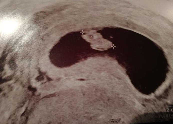 ultraschall 9 ssw