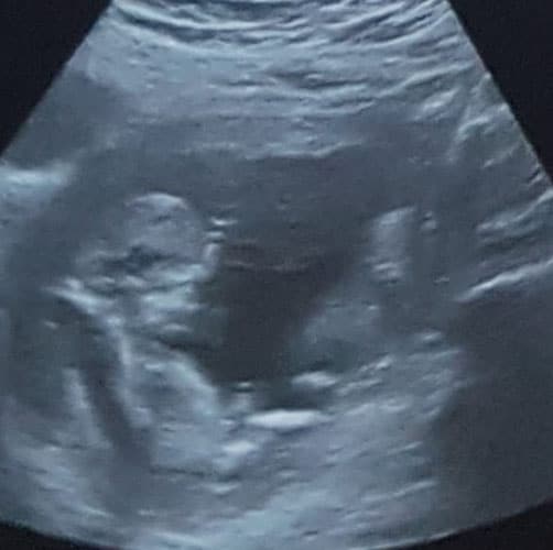 Ultraschallbild in der 13. SSW