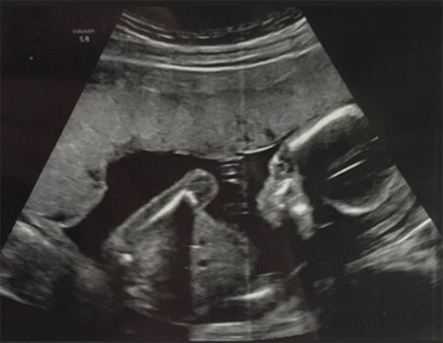 ultraschall 18 ssw junge